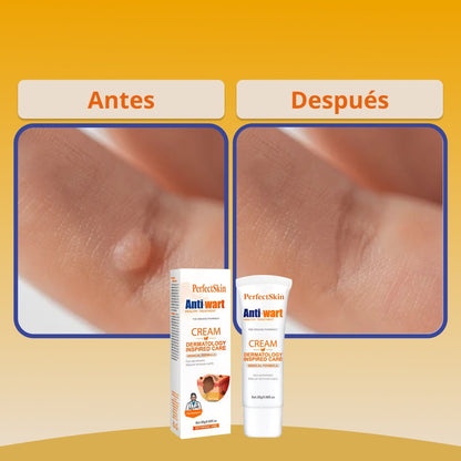 PerfectSkin® | Crema Profesional para Eliminar Verrugas y Manchas de la Piel